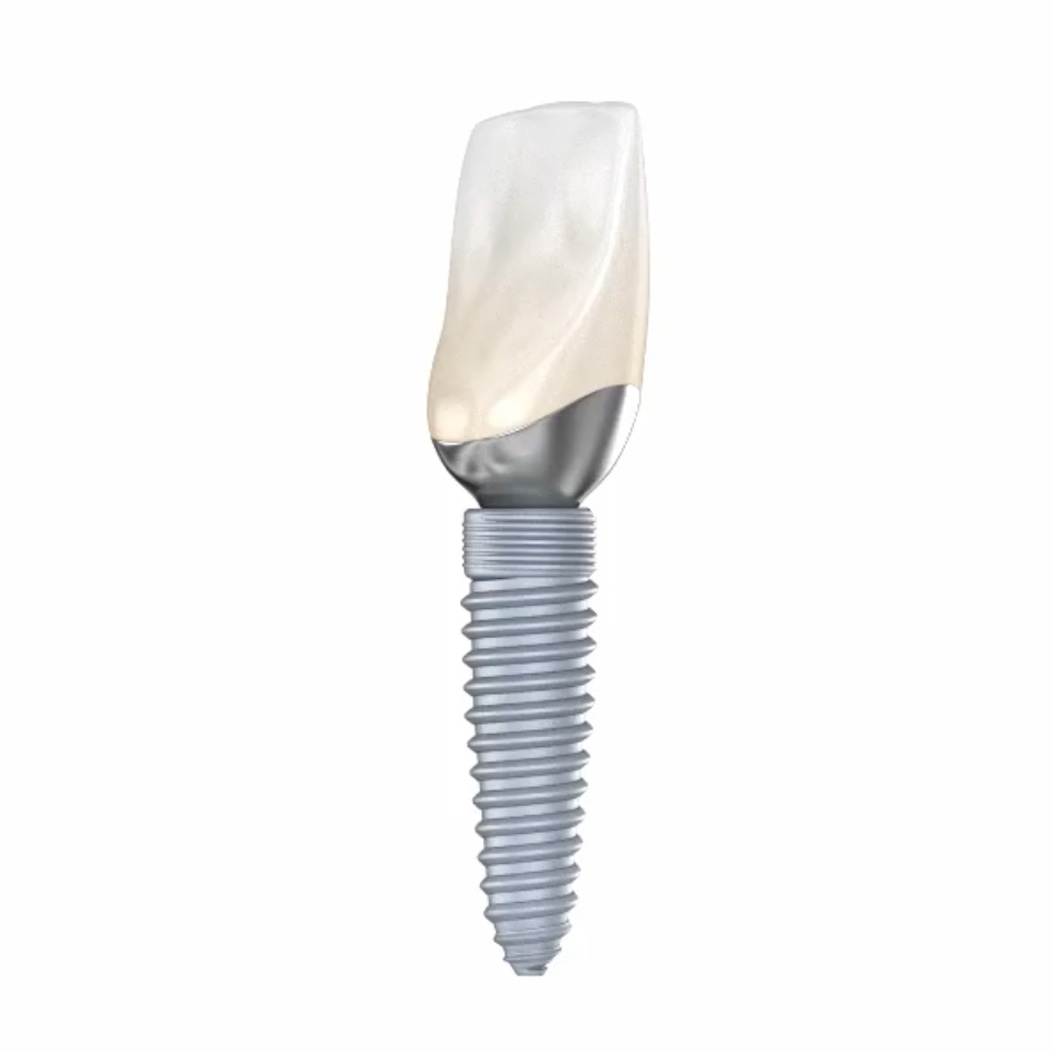 Image of a Dental Implant