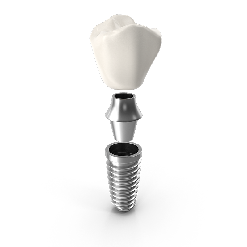 Anatomy of a Dental Implant